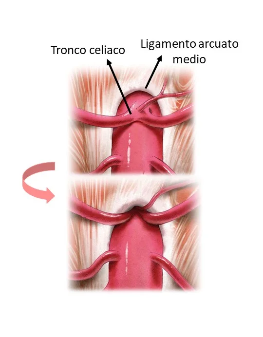 tronco celiaco