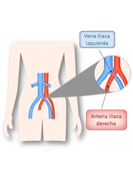 vena y arteria iliaca izquierda