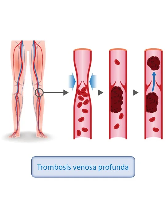 trombosis venosa profunda