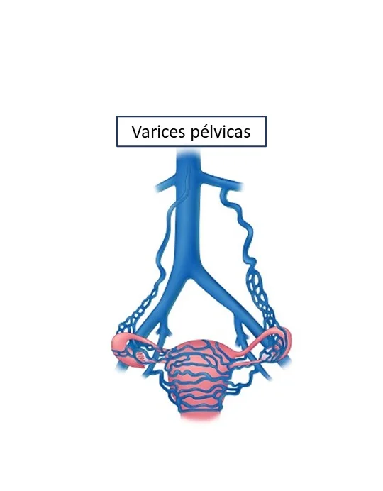 varices pélvicas