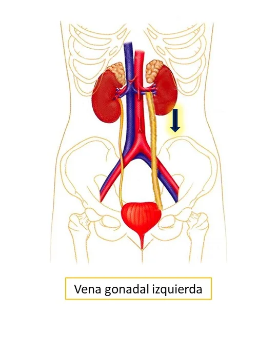 vena gonadal izquierda