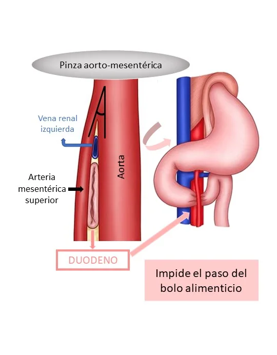 pinza aorto-mesenterica