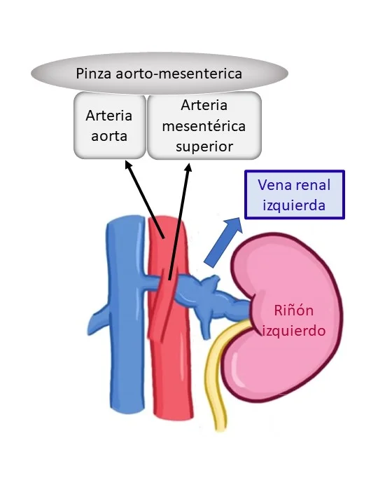 cascanueces pinza aorto-mesenterica