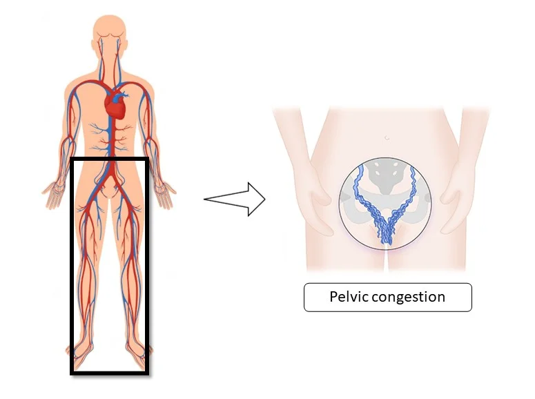 AESCOV  Congestión pélvica