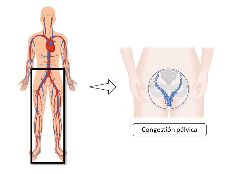 congestión pélvica